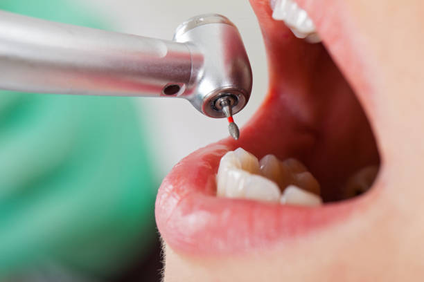 Best Emergency Root Canal Treatment in Fairmount, GA